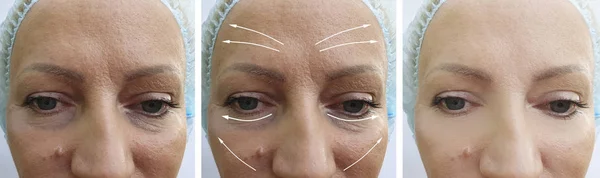 Woman Wrinkles Correction Procedures — Stock Photo, Image