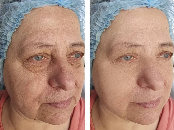 Морщины Лице Пожилой Женщины После Процедур — стоковое фото