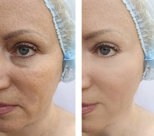 Arrugas Cara Mujer Antes Después Procedimientos Eliminación — Foto de Stock