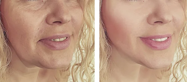 Frauenfalten Gesicht Vor Und Nach Korrekturmaßnahmen — Stockfoto