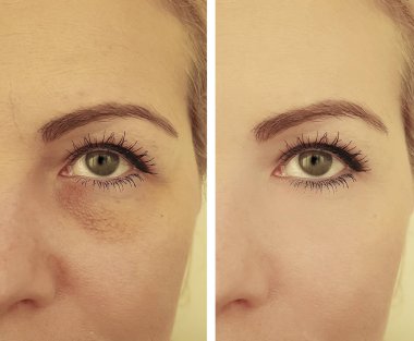 kadın kırışıklıkları yüz öncesi ve sonrası düzeltme işlemleri