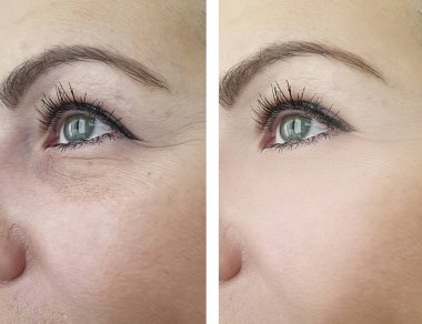 kadın kırışıklıkları yüz öncesi ve sonrası düzeltme işlemleri