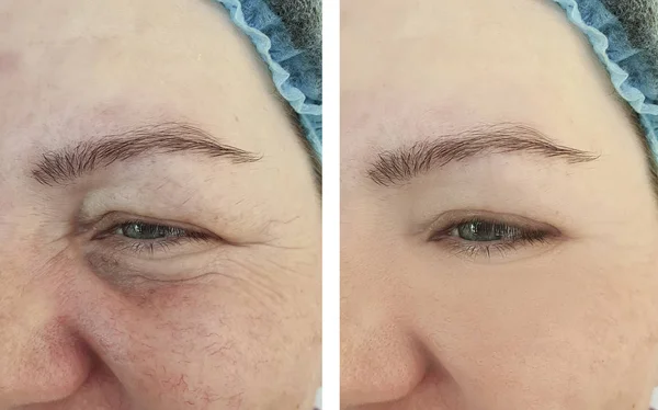 Wanita Keriput Wajah Sebelum Dan Setelah Prosedur Rosacea — Stok Foto