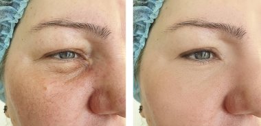 Kadının yüzü ameliyattan önce ve sonra kırışır, Rosacea.