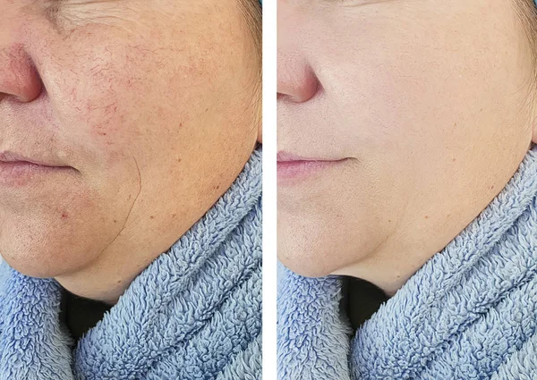 woman wrinkles face before and after procedures, rosacea