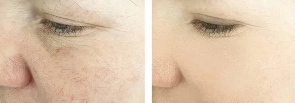 Wanita Keriput Wajah Sebelum Dan Setelah Prosedur Rosacea — Stok Foto