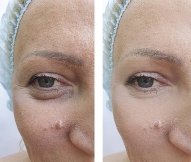 kadının yüz kırışıklıklar daha önce ve sonra yordamları