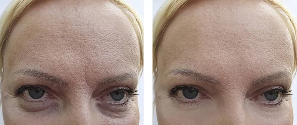 woman\'s wrinkles face before and after the procedures