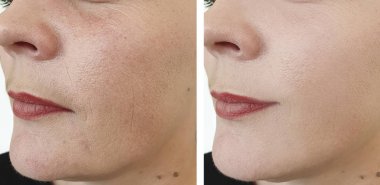 düzeltme öncesi ve sonrası kadın yüz kırışıklıkları