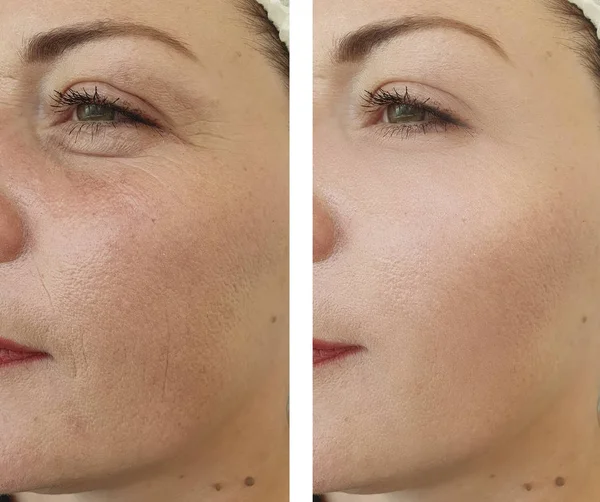 Female Face Wrinkles Correction — Stock Photo, Image