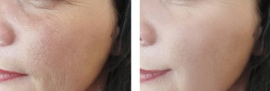 düzeltme öncesi ve sonrası kadın yüz kırışıklıkları