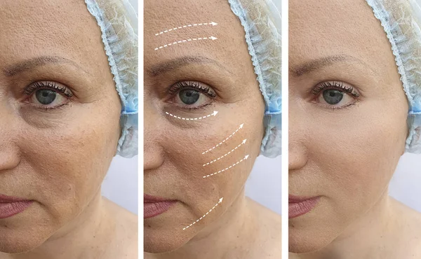 woman face wrinkles before and after correction collage