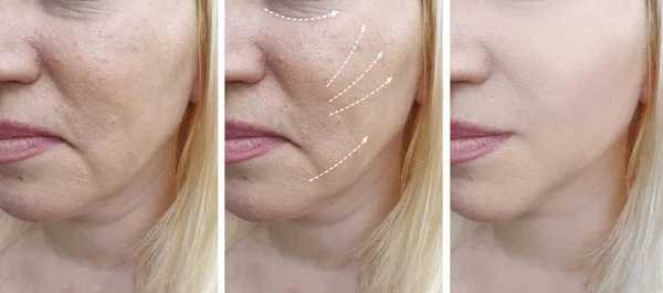 woman face wrinkles before and after correction collage