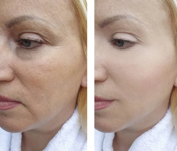 Woman Wrinkles Treatments — Stock Photo, Image