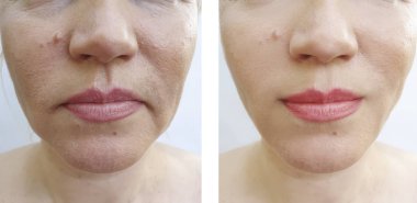 kadın yüz kırışıklıklar öncesi ve tedavi sonrası