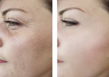 kadın yüz kırışıklıklar öncesi ve tedavi sonrası