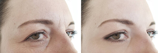 woman face wrinkles before and after treatments