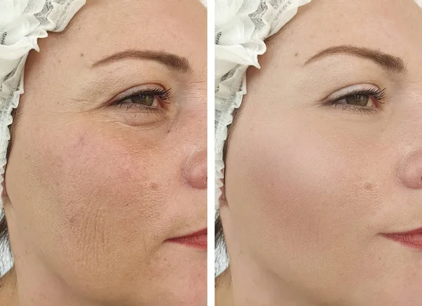 Arrugas Cara Mujer Antes Después Tratamientos — Foto de Stock