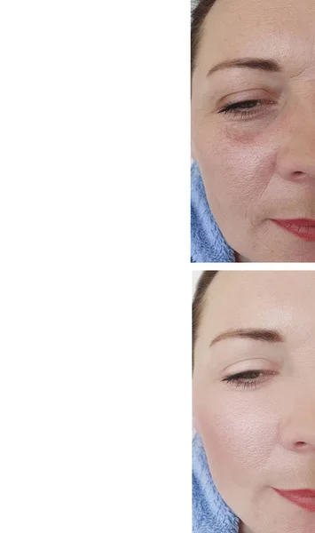 Blähungen Der Weiblichen Augen Vor Und Nach Der Behandlung — Stockfoto