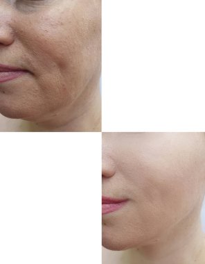 kadın kırışıklıkları yüz işlemden önce ve sonra