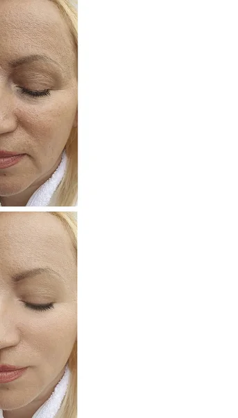 Arrugas Mujer Cara Antes Después Del Tratamiento —  Fotos de Stock