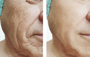 yaşlı adam tedavi öncesi ve sonrası kırışıklıklar