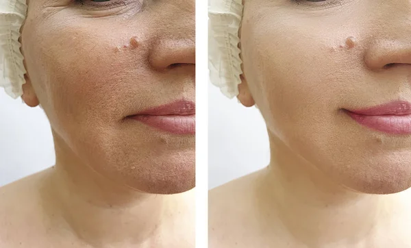 woman face wrinkles before and after treatment