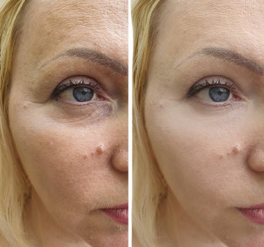 Kadın tedaviden önce ve sonra kırışıklıklarla karşılaşır