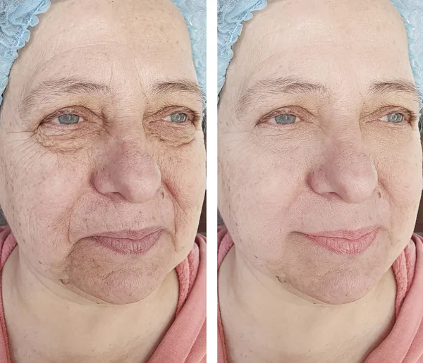 Face Old Woman Wrinkles Procedures — Stock Photo, Image