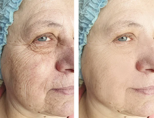 Cara Una Anciana Arrugas Antes Después Los Procedimientos —  Fotos de Stock