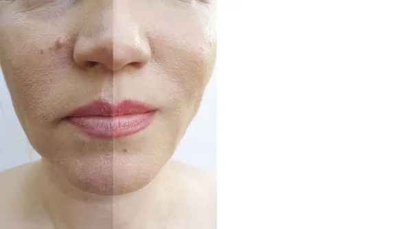 Cara Mujer Arrugas Antes Después Los Procedimientos — Foto de Stock