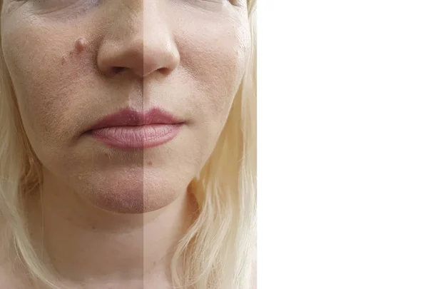 Falten Gesicht Der Frau Vor Und Nach Eingriffen — Stockfoto