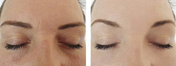 female face wrinkles before and after procedures