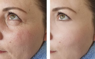 işlemler öncesi ve sonrası kadın yüz kırışıklıkları