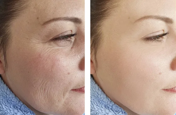 Rugas Faciais Femininas Antes Depois Dos Procedimentos — Fotografia de Stock