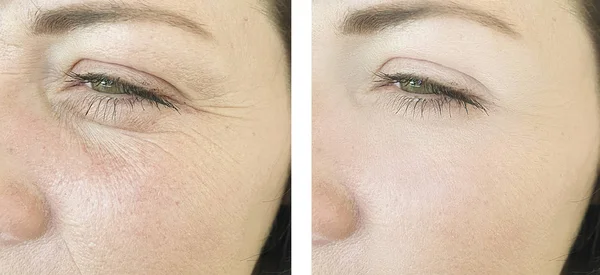 Female Face Wrinkles Procedures — Stock Photo, Image