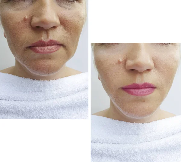 Woman Face Wrinkles Correction — Stock Photo, Image
