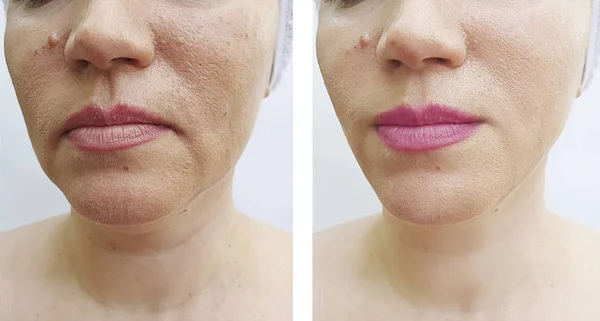 Woman Face Wrinkles Correction — Stock Photo, Image