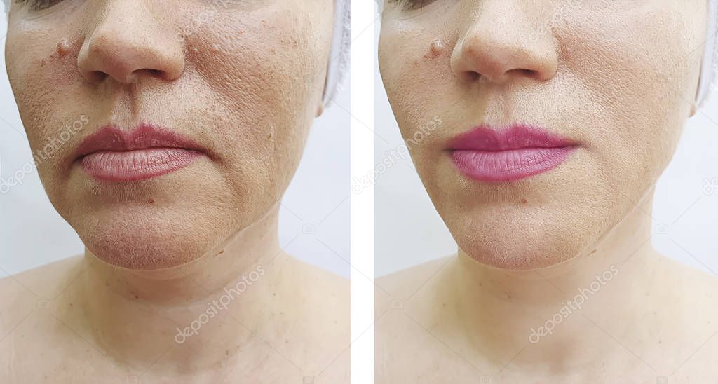 woman face wrinkles before and after correction