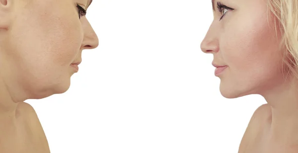 Woman Double Chin Procedures Effect — Stockfoto