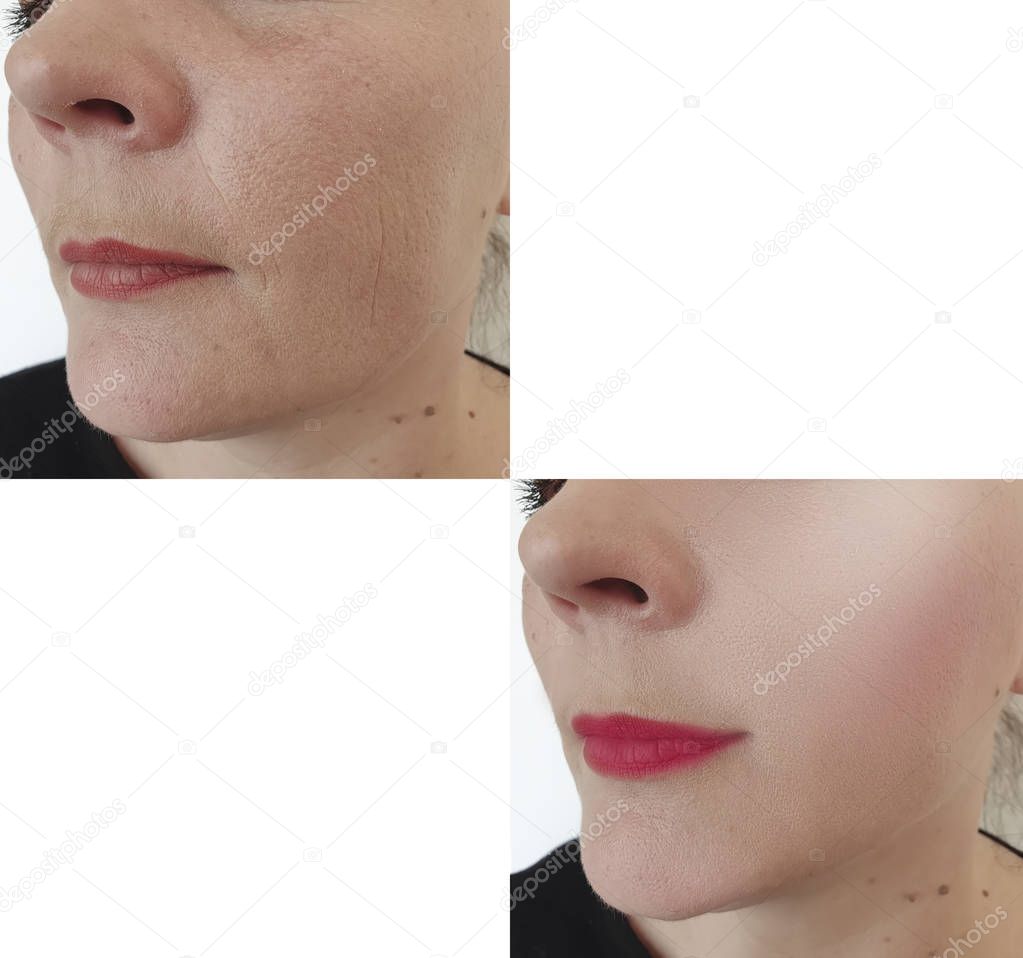 female face wrinkles before and after procedures