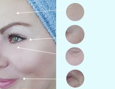 kadın yüz kırışıklıklar önce ve sonra düzeltme