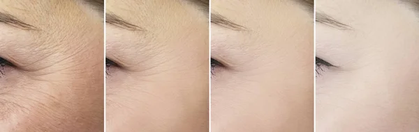 Rugas Dos Olhos Mulher Antes Depois Colagem — Fotografia de Stock