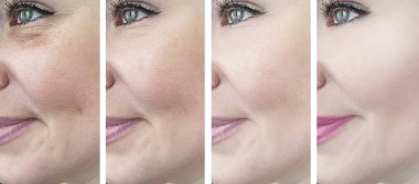 Kadın gözlerinde tedavi öncesi ve sonrası kırışıklıklar var.