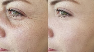 kadın yüz kırışıklıklar önce ve sonra düzeltme