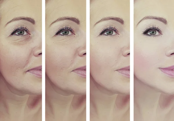 Wanita Keriput Wajah Sebelum Dan Setelah Perawatan Kolase — Stok Foto