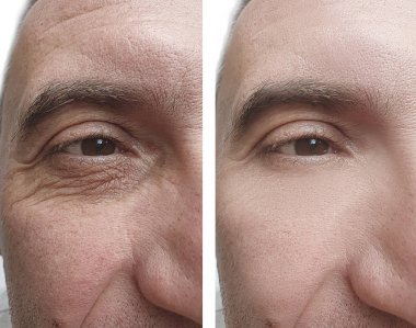 erkek yüz kırışıklıklar öncesi ve tedavi sonrası