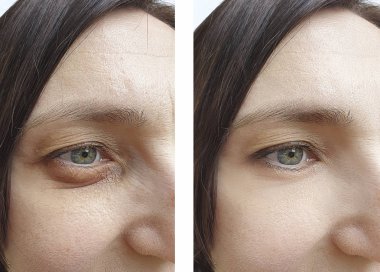 Kadın tedaviden önce ve sonra kırışıklıklarla karşılaşır