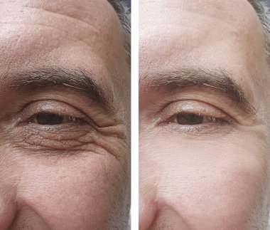 erkek göz kırışıklıkları öncesi ve sonrası tedaviler