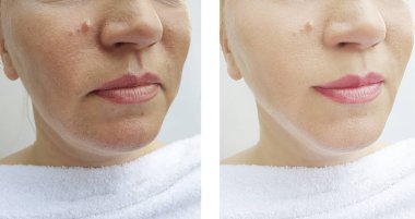 kadın kırışıklıkları yüz öncesi ve tedavi sonrası